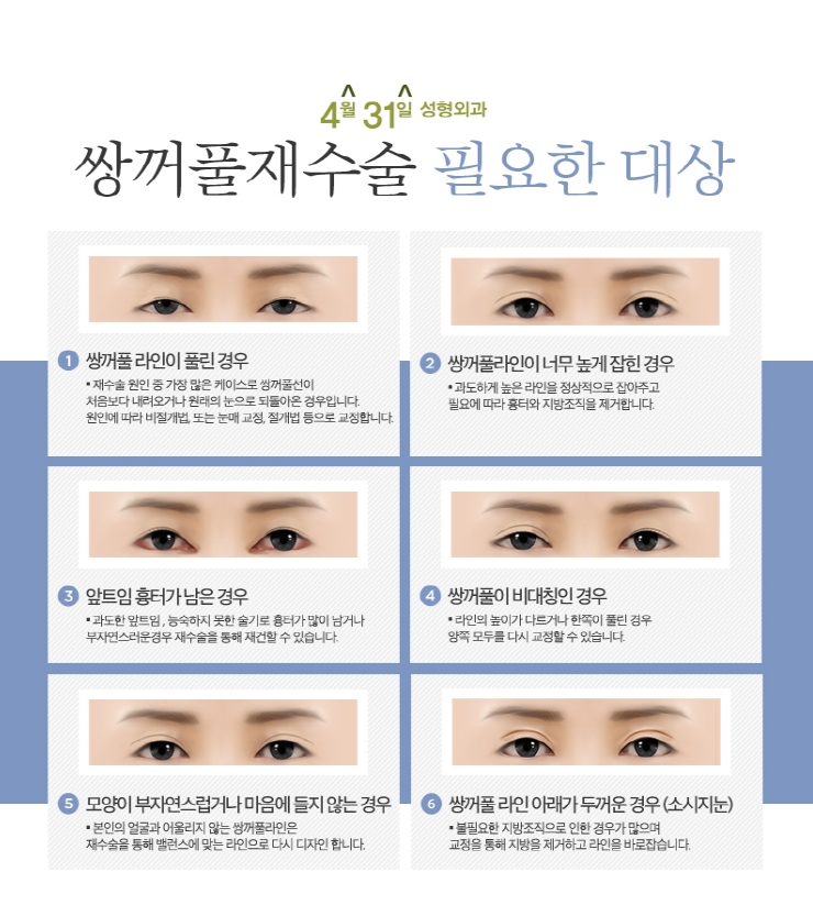 쌍꺼풀재수술후기 4월31일성형외과의 만족감! 관련 이미지 4