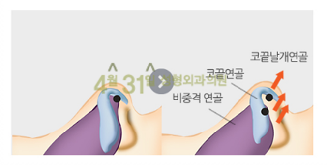 코성형잘하는곳 4월31일성형외과의원 긴코성형 관련 이미지 4