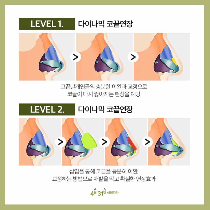들창코재수술잘하는곳 4월31일성형외과에서 관련 이미지 4