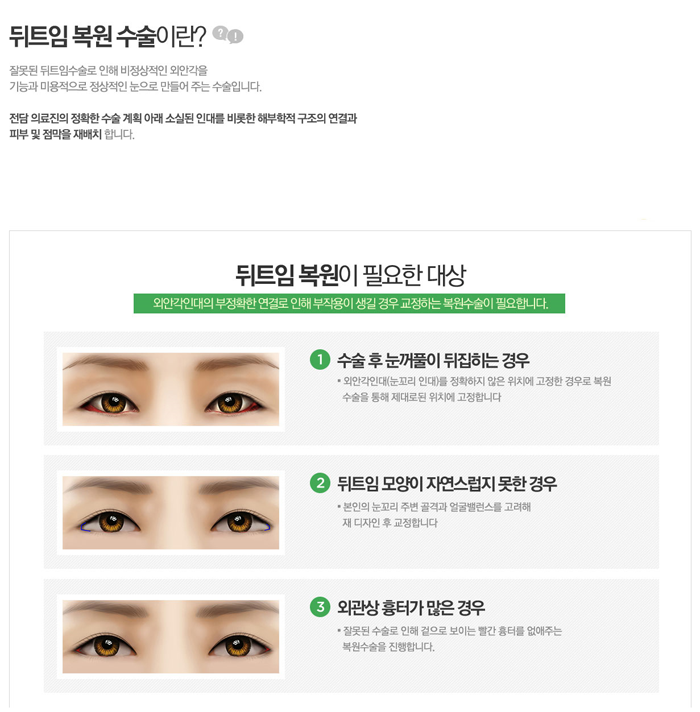 앞트임복원수술 4월31일성형외과라면 자연스럽게 관련 이미지 3