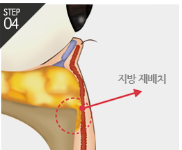 [Eye Plastic Surgery] Middle-Aged Eye Surgery to Improve Uneven Under-Eyes! Lower Blepharoplasty image 7