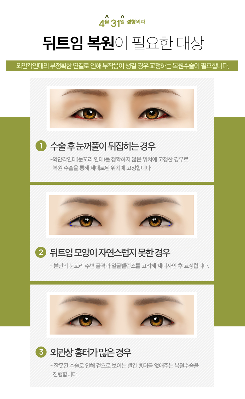 뒤트임복원 4월31일성형외과에서 해결하세요 관련 이미지 3