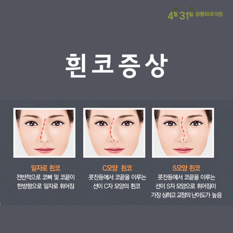 휜코성형수술 할때는 4월31일성형외과의원 관련 이미지 3