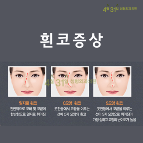 휜코수술잘하는곳 4월31일성형외과의원에서 바르게 관련 이미지 2