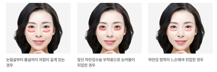 리프팅의 신세계, 4/31 중안면 거상술 관련 이미지 4