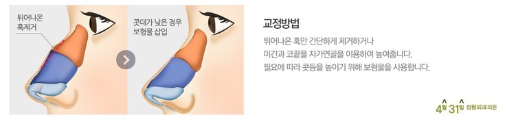 매부리코수술잘하는병원 추천 4월31일성형외과의원 관련 이미지 3