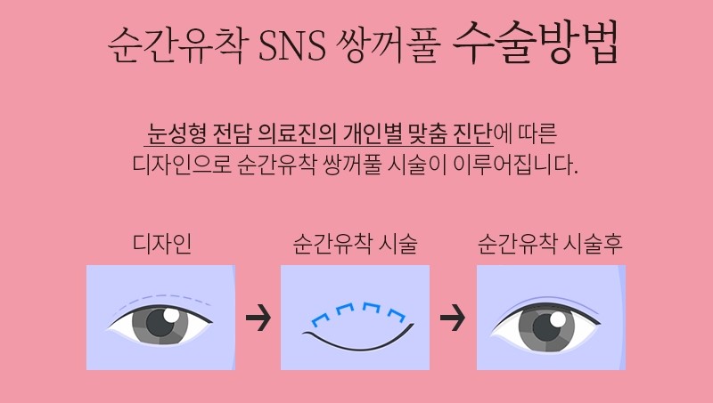 쌍꺼풀성형외과 4월31일성형외과의 순간유착 관련 이미지 2