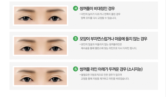 쌍꺼풀재수술병원 하나하나 따져봐도 4월31일성형외과의원 관련 이미지 2