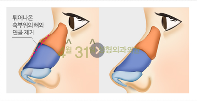 매부리코교정 4월31일성형외과의원에서 굴곡없이 관련 이미지 3