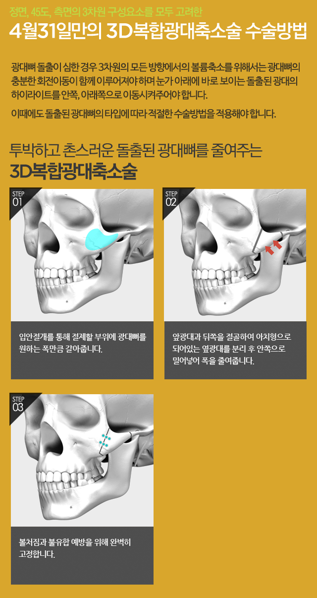 옆광대수술 4월31일성형외과의원의 효과! 관련 이미지 2