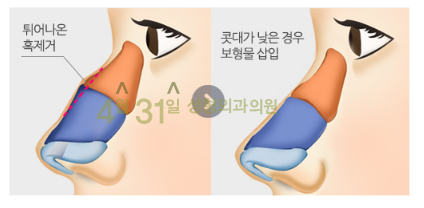 매부리코교정 확실하게 4월31일성형외과에서 관련 이미지 3