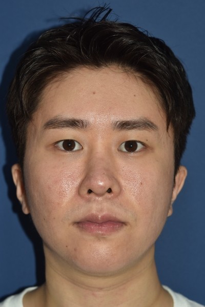믿을수 있는 구축코재수술 전문 4월31일성형외과 관련 이미지 7