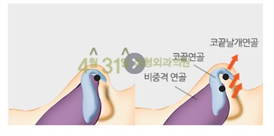 코성형잘하는곳 4월31일성형외과의원 긴코성형 알아봐요 관련 이미지 4