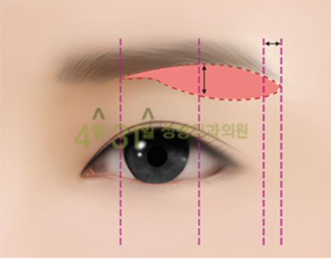 상안검수술 4월31일성형외과의원에서 자연스럽게 관련 이미지 3