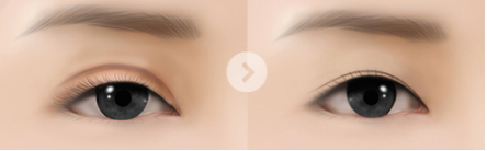 [Eyelid Volume Up] Take Another Look at Sunken Eyes! Eyelid Volume Up Surgery image 3