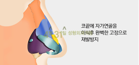 구축코재수술은 4월31일성형외과에서 관련 이미지 5