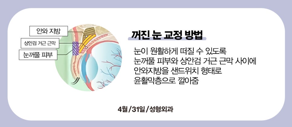 [Eye Surgery] Swelling and Scarring After Double Eyelid Surgery image 7