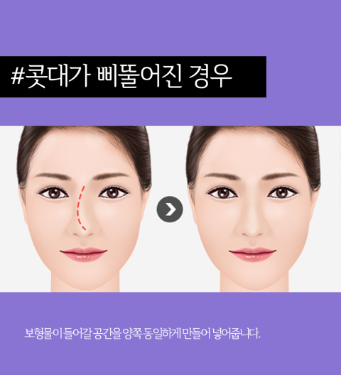 The Difference Between Experience and Skill! April 31 Plastic Surgery, Specialist in Nose Revision Surgery image 2