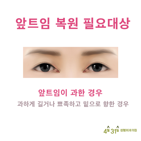 앞트임재건후기 추천병원 4월31일성형외과의원 관련 이미지 4