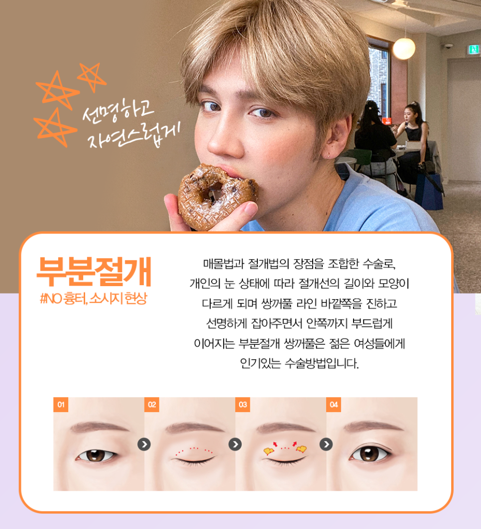 쌍수추천병원 에서 말하는 눈성형종류 관련 이미지 3