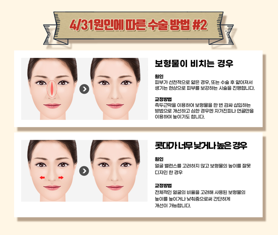 코재수술유명한성형외과 난이도 높은 코도 OK 관련 이미지 5
