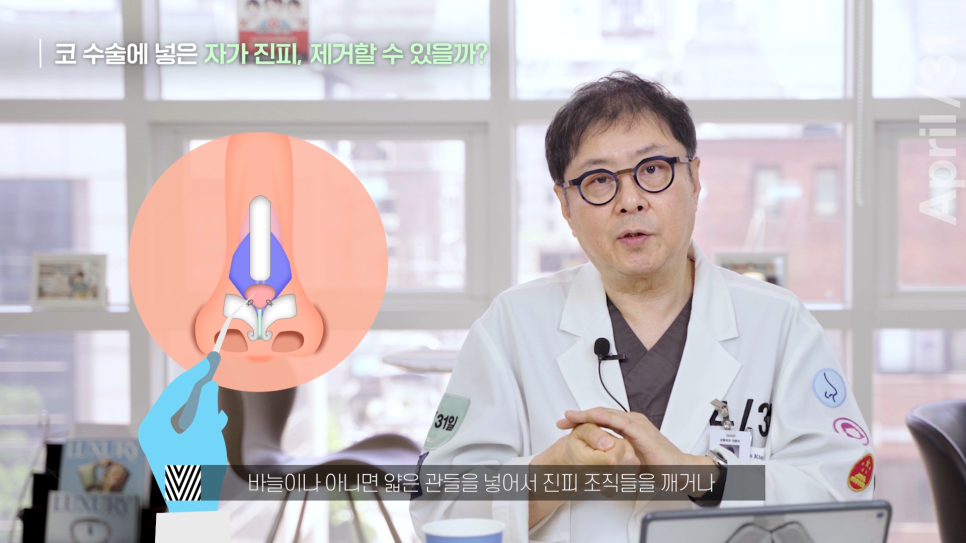 [코성형] 코에 넣은 자가진피, 마음에 안든다면? 관련 이미지 5