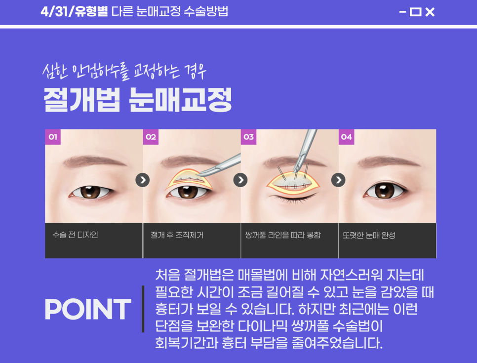 Recommended Hospital for Eye Shape Correction: Say Goodbye to Sleepy Eyes! image 4