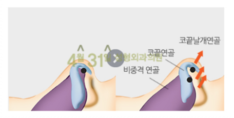 화살코성형, 긴코성형 안전하게 4월31일성형외과의원에서 관련 이미지 4
