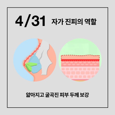 [코성형] 코에 넣은 자가진피, 마음에 안든다면? 관련 이미지 7