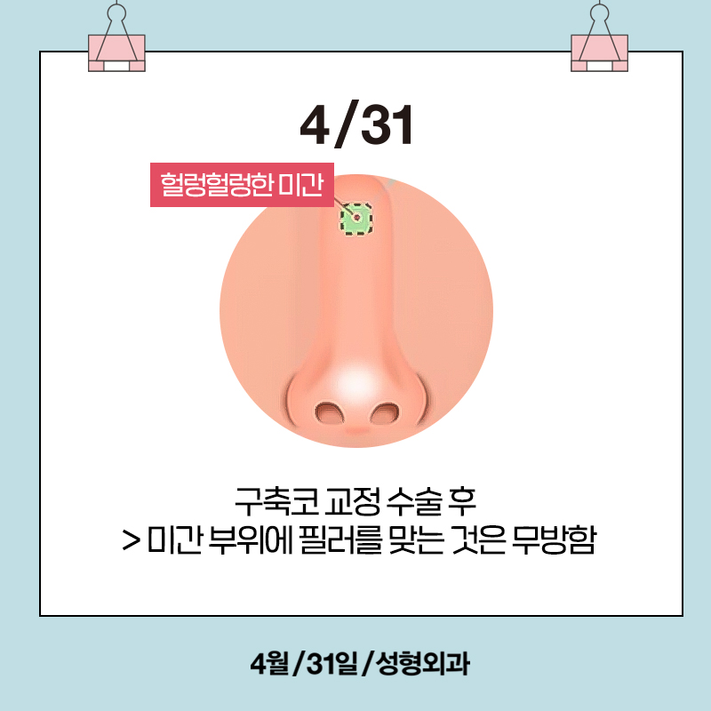 [Contracted Nose] Deep Analysis of the 5-Step Contracted Nose Correction Surgery Part 01_ Sufficient Dissection and Release image 8
