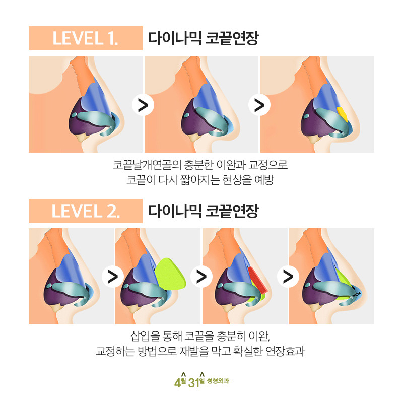 들창코수술비용 부담스럽지 않게 관련 이미지 4