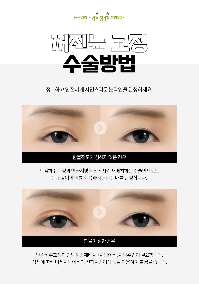 눈위꺼짐교정방법 오래가는 도톰한 볼륨을 원한다면? 관련 이미지 7