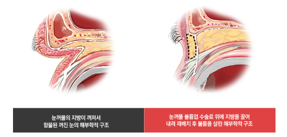 나이 들어보이는 꺼진눈 고민이라면? (feat.눈꺼풀 볼륨업) 관련 이미지 4