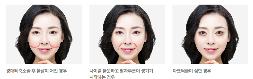 리프팅의 신세계, 4/31 중안면 거상술 관련 이미지 5