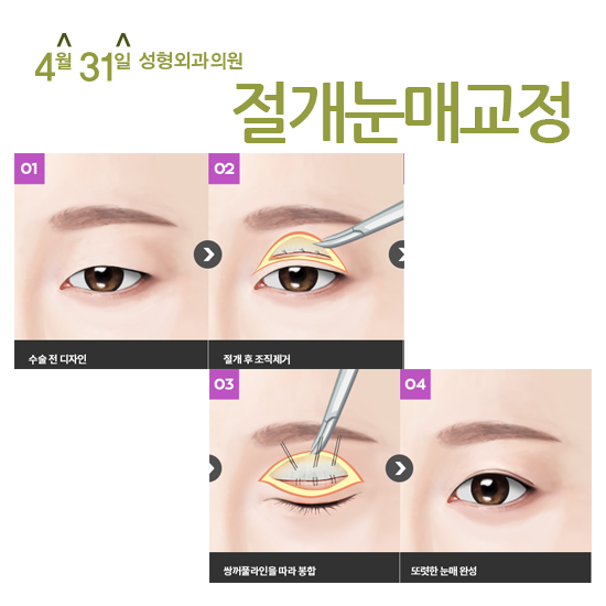 안검하수 눈매교정으로 또렷한 눈매로 거듭나다! 관련 이미지 5