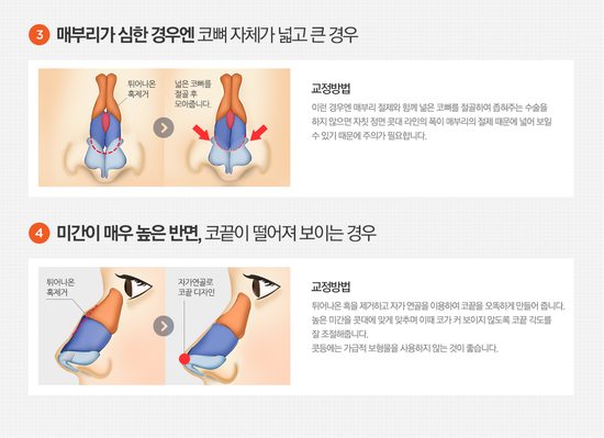 매부리코수술잘하는병원 4월31일성형외과의원 추천! 관련 이미지 3