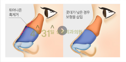 매부리코수술잘하는병원 고민하고 계신가요? 관련 이미지 3