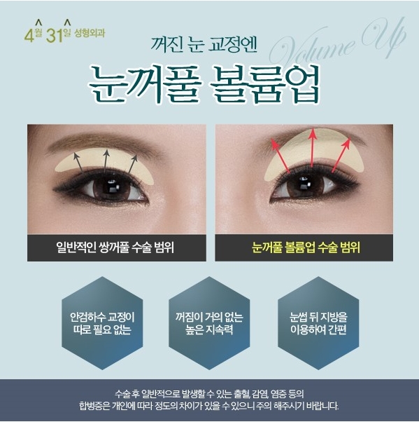 꺼진눈성형 볼륨있는 동안눈매 관련 이미지 2
