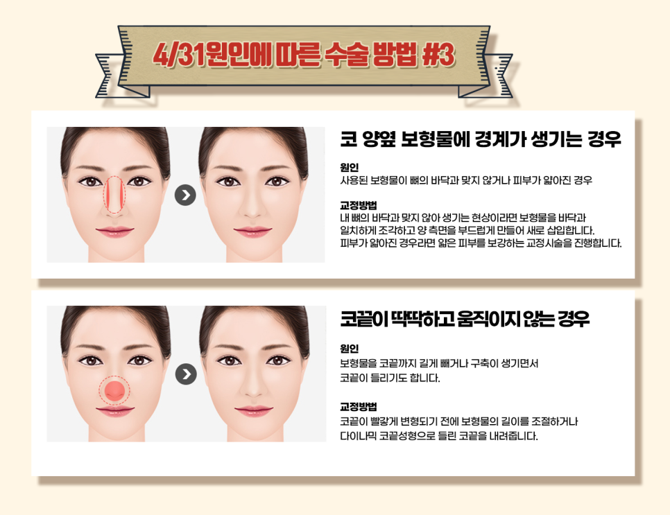코재수술유명한성형외과 난이도 높은 코도 OK 관련 이미지 6