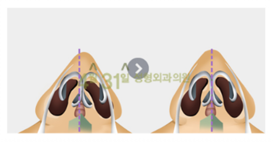 휜코성형잘하는곳 찾는다면? 4월31일성형외과의원 관련 이미지 3