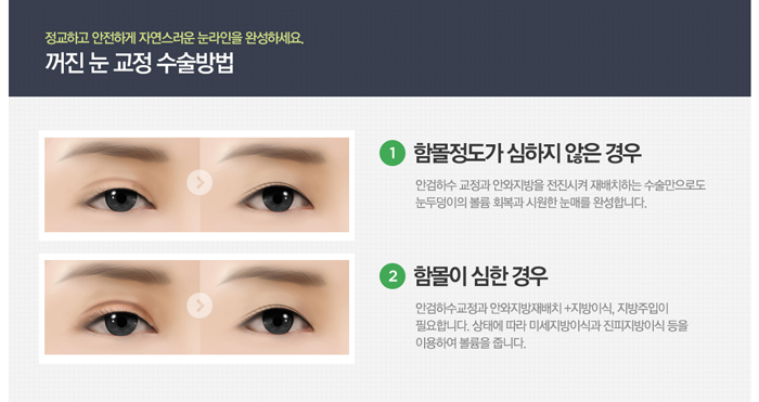 눈꺼풀지방이식 낮은 생착률 극복한 4월31일성형외과 관련 이미지 4