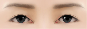 [Eye Revision Surgery] A Difference Made by a Small Detail image 5