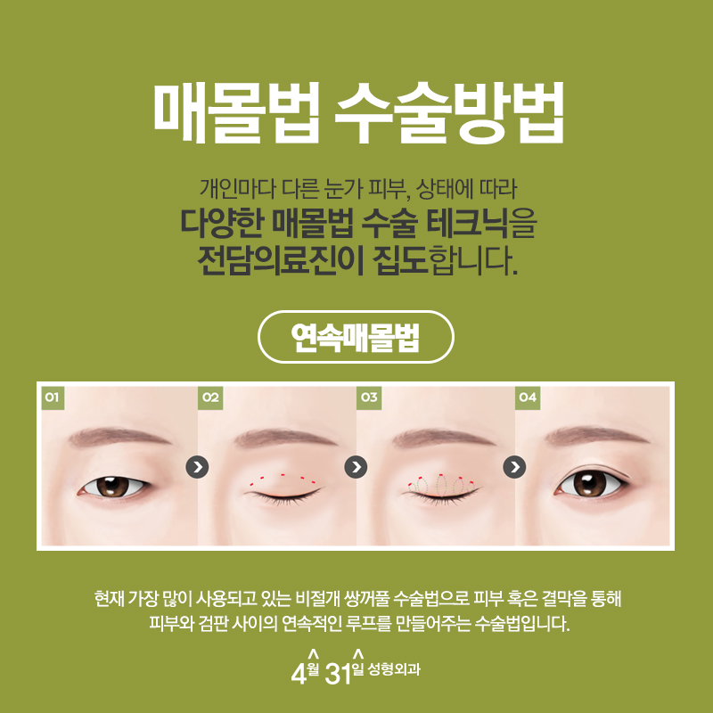 강남매몰잘하는곳 4월31일성형외과 남다른 결과 관련 이미지 4