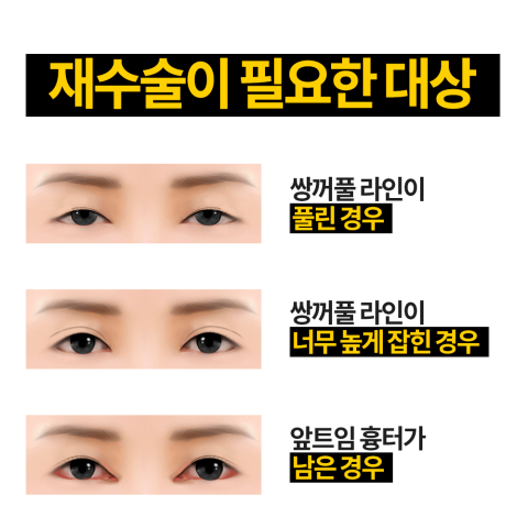 눈재수술잘하는병원 4월31일성형외과! 관련 이미지 3
