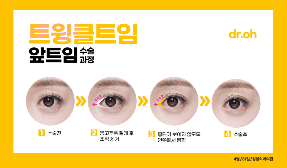 Back Canthoplasty and Lower Canthoplasty Price: If You Want a Bright, Open Eye Shape, Try Twinkle Canthoplasty! image 3