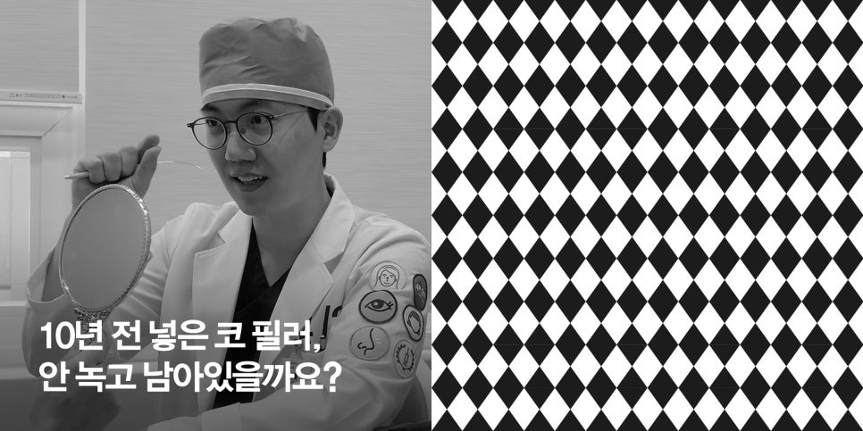 [April 31 Plastic Surgery] Will a nose filler injected 10 years ago still be there without dissolving? image 1