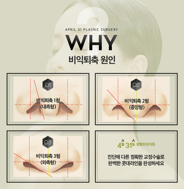 콧구멍축소 콧끝들림 없이 교정하기 관련 이미지 3