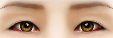 [Eye Revision Surgery] A Difference Made by a Small Detail image 8