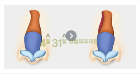 휜코수술잘하는곳 4월31일성형외과의원에서 바르게 관련 이미지 4