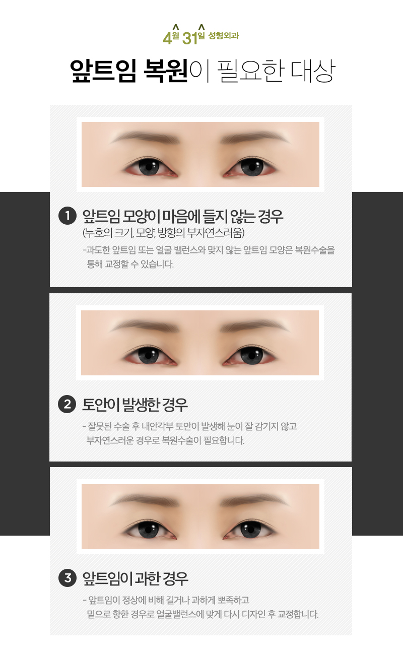 앞트임복원수술 자연스러움이 중요해요! 관련 이미지 3